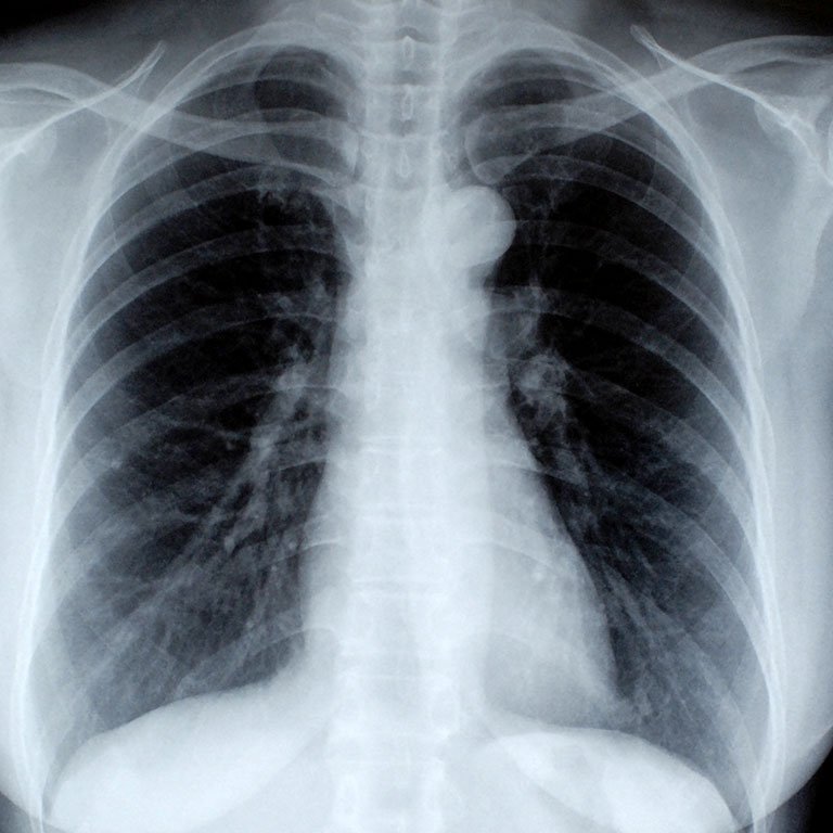 Enfermedades Pulmonares Crónicas
